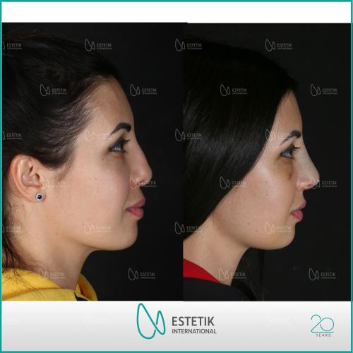 Septoplasty Before / After photo